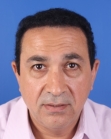 After Hair Transplant &nbsp;Front